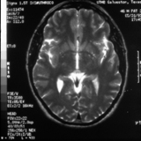 Looking Down MRI View of My Brain
